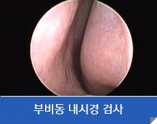 부비동 내시경 검사