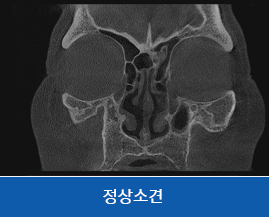 비정상소견