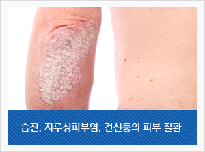 습진, 지루성피부염, 건선등의 피부 질환